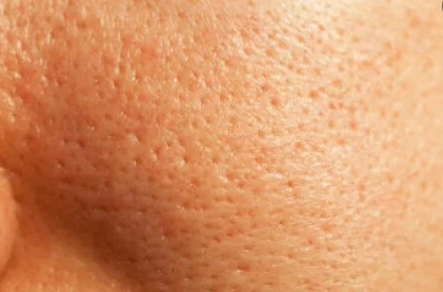 리쥬란 하지 마세요 (효과없는 경우/효과좋은 경우) 사진 4