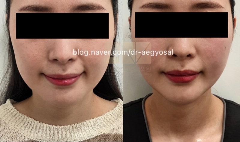 청담안즈 티타늄 전후사진