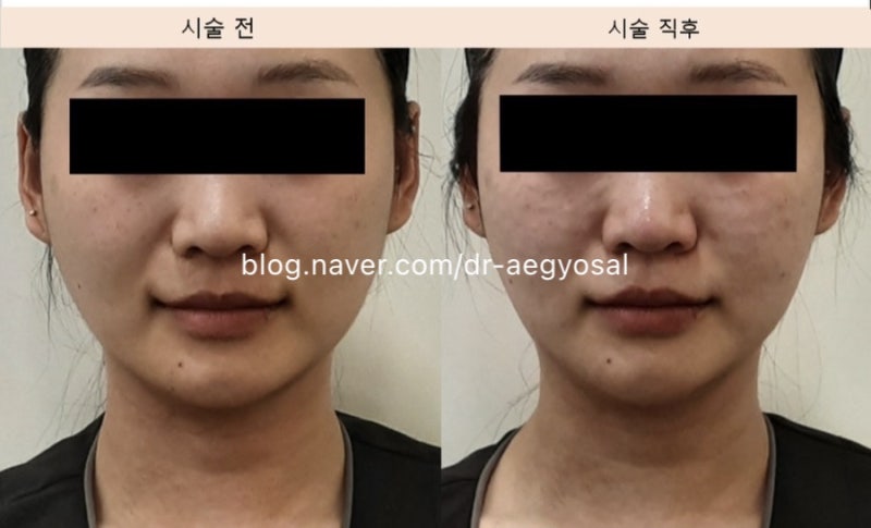 청담안즈 티타늄 전후사진