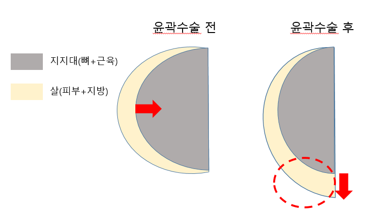 윤곽수술 후 처지는 분들 필독.