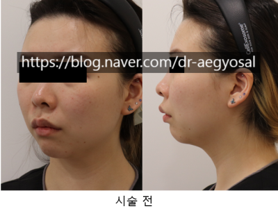 초음파윤곽술 후기/超音波輪廓术 评论/ultrasoniclipolysis review 사진 4