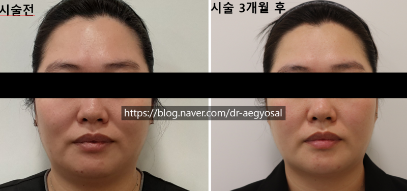 초음파윤곽술 후기/超音波輪廓术 评论/ultrasoniclipolysis review 사진 6