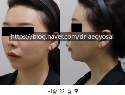 초음파윤곽술 후기/超音波輪廓术 评论/ultrasoniclipolysis review 사진 5