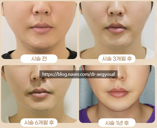 초음파윤곽술 후기/超音波輪廓术 评论/ultrasoniclipolysis review 사진 3