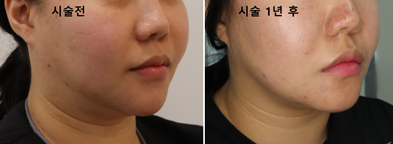 초음파윤곽술 후기/超音波輪廓术 评论/ultrasoniclipolysis review 사진 9