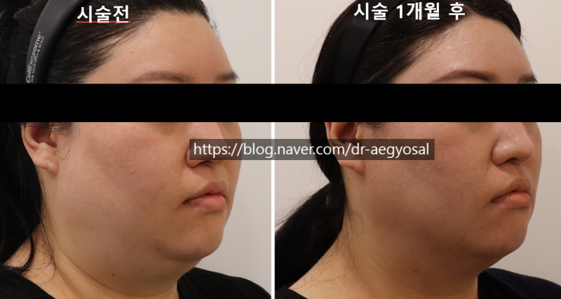 초음파윤곽술 후기/超音波輪廓术 评论/ultrasoniclipolysis review