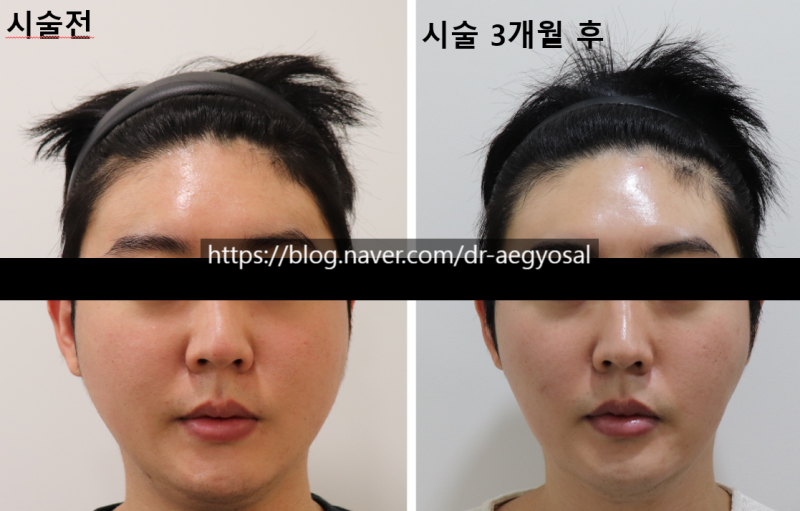 초음파윤곽술 후기/超音波輪廓术 评论/ultrasoniclipolysis review 사진 2