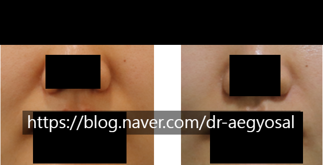 청담안즈 쥬베룩볼륨 후기