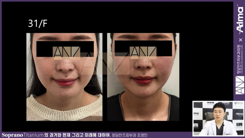티타늄리프팅 학회강의 (2023.11)