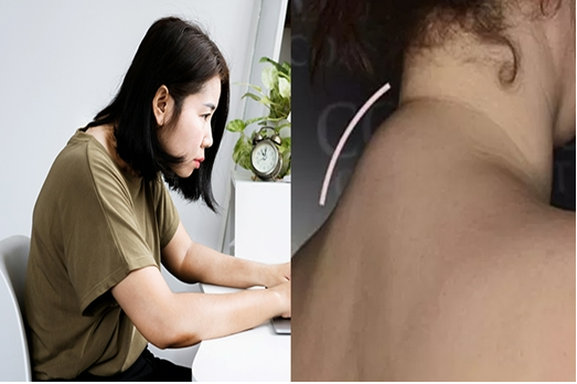 버섯목증후군/버팔로험프/뒷목굳은살 의 모든 것 (수술적 치료) 사진 8