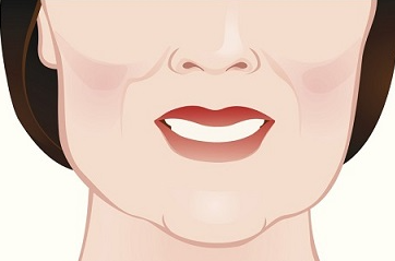 리프팅의 본질 사진 4